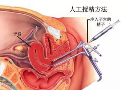 哪些人可以做人工授精